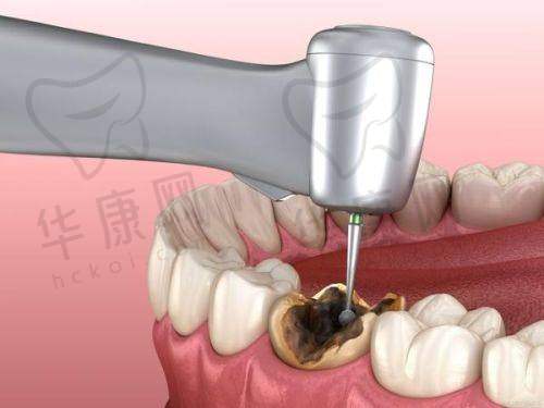 达州医大口腔医院儿童根管治疗的成功实例