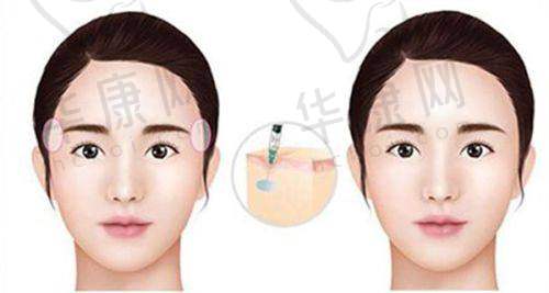 选择郴州唯美医疗美容肋骨鼻项目的注意事项