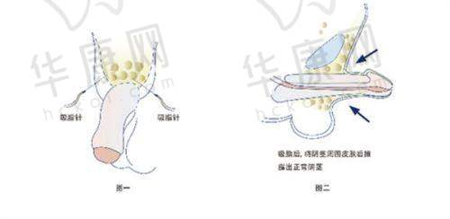 找重庆松山整形肖林做面部轮廓，地包天、凸嘴等问题改善，恢复后效果超自然！