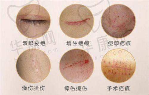 郴州唯美医疗美容肋骨鼻项目与其他隆鼻方式对比