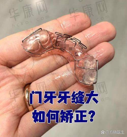 西安弗莱堡口腔校华时代天使隐形矫正的其他配套优势