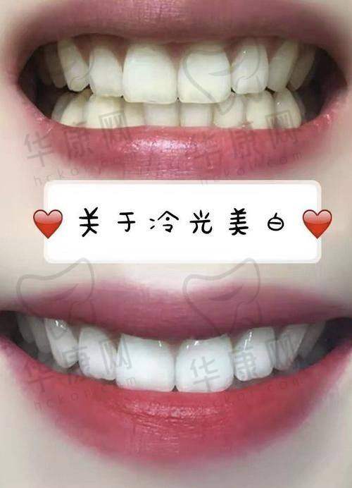 湖南湘西口腔医院冷光美白的成功实例