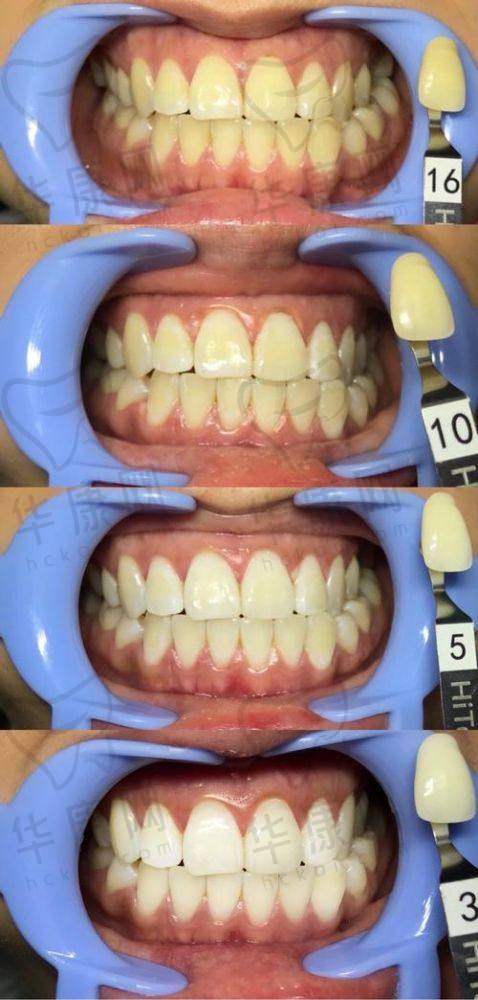 重庆种博士口腔3D超薄全瓷贴面的医院优势