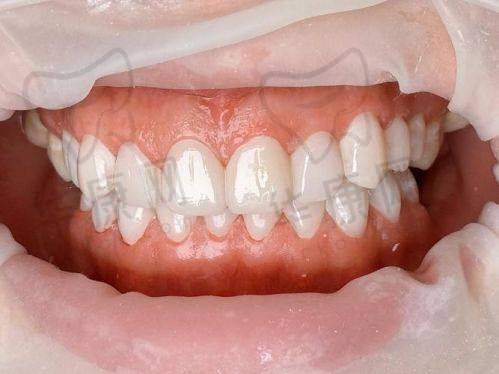重庆种博士口腔3D超薄全瓷贴面的成功实例