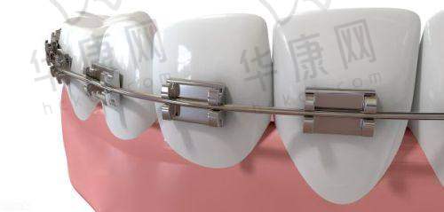 东莞南城贝壳美牙口腔李裕锋正雅悦享隐形矫正仅13800元起，超划算！