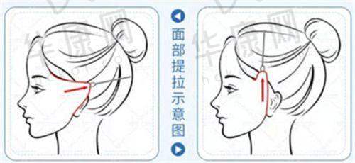 常德曹家整形医疗美容医院王琳吸脂之手术过程