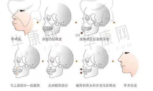深圳张辉医生隆鼻价格为何如此透明?