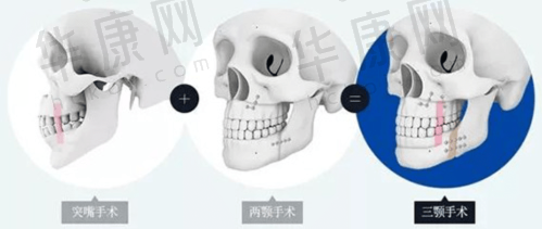 广州韩妃李光琴双眼皮手术怎么样？医院实力、医生技术与术后效果全揭秘