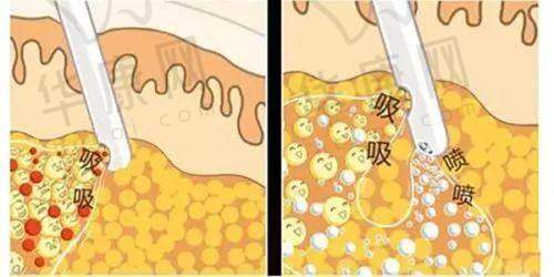 深圳张辉隆鼻避雷是假的！技术审美服务佳，4万赫本鼻套餐性价比超高