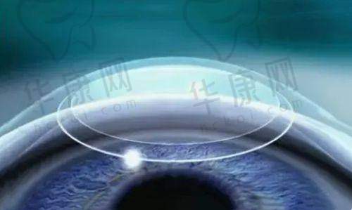 长沙天心睛点眼科医生在个性化全激光手术方面的优势
