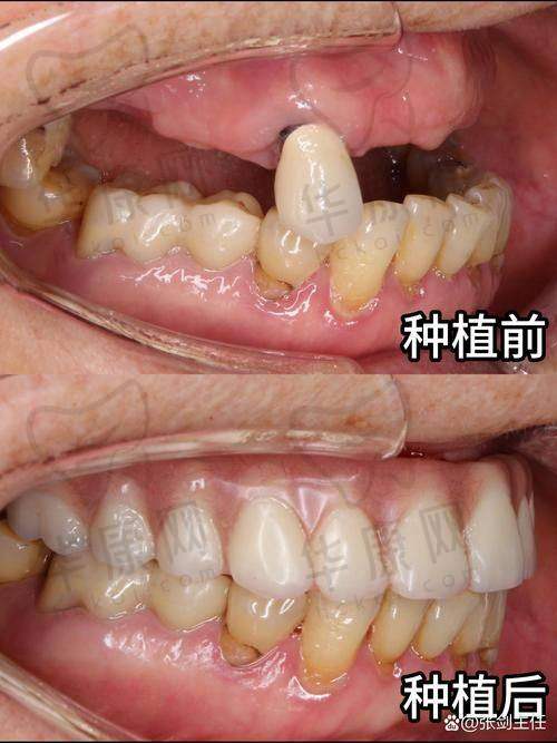 西双版纳竹子口腔医院贺光亮瑞士士卓曼ITI种植牙实例展示
