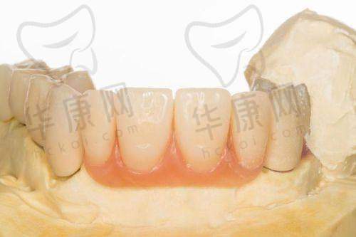 汕头牙加美口腔医院钴铬烤瓷冠680元起，高性价比修复之选别错过！
