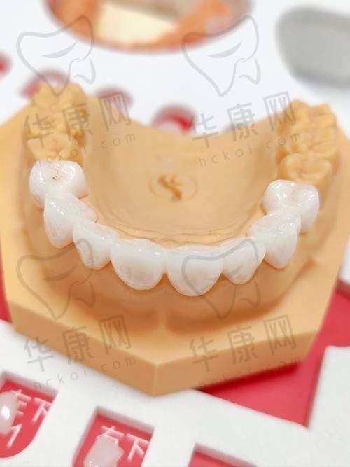 东莞南城贝壳美牙口腔LAVA全瓷冠的服务优势