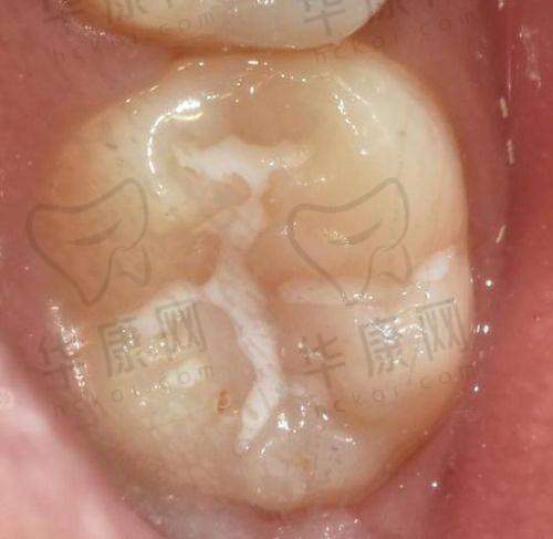深圳贝壳口腔儿童单颗窝沟封闭的实际实例