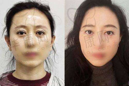 顾客对合肥壹加壹美容医院马路微创双眼皮的反馈