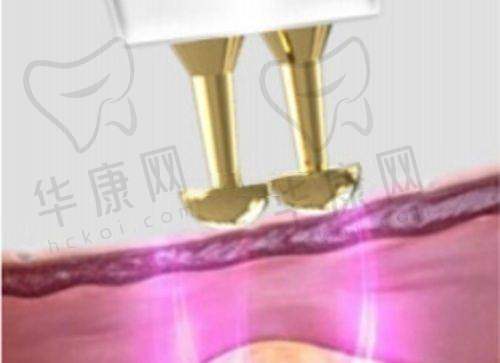 成功实例见证济南韩氏整形韩啸美国曼托假体丰胸的成效