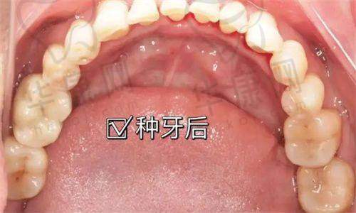 重庆中三口腔韩国奥齿泰种植牙2380元起，高性价比之选不容错过！
