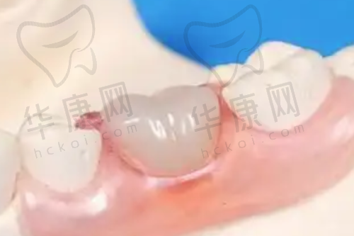 肥城可恩口腔医院儿童3MP60树脂补牙的服务保护