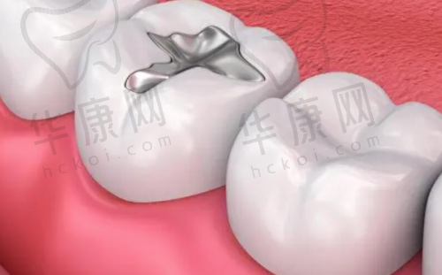 汕头牙加美口腔医院3MP60树脂补牙380元起，耐磨抗压搞定后牙缺损！