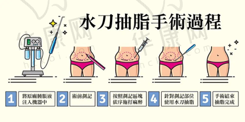 咸阳215医院割双眼皮，实际实例成效如何？