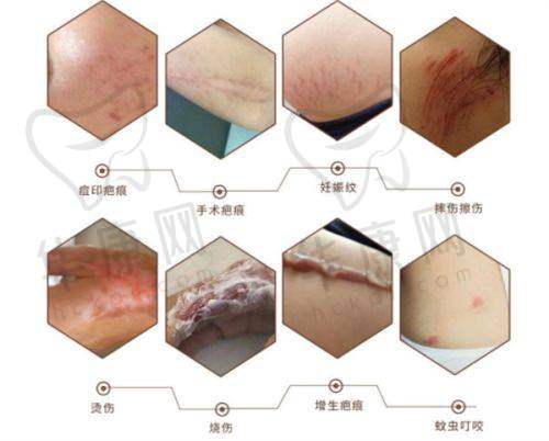 中山韩妃整形美容双眼皮实例成效