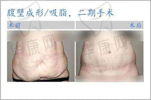 咸阳215医院割双眼皮，失败修复相关知识知多少？