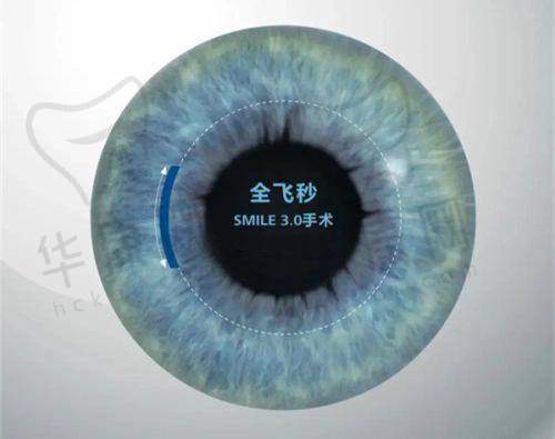 昆明普瑞眼科千频优视飞秒手术16800元起，高端设备与经验医生打造优质视力矫正！