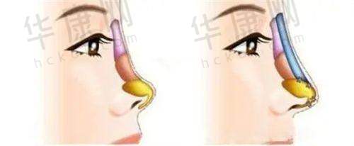 太原欧美莲整形吸脂之医生技术