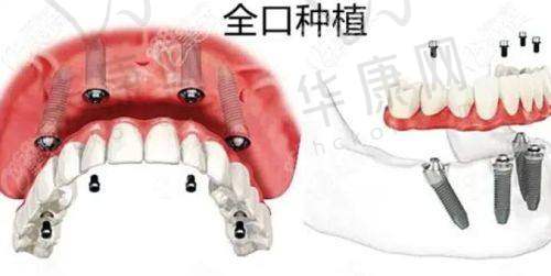 重庆中三口腔全口仕诺康种植牙的医生优势