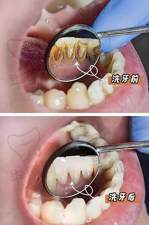 肥城可恩口腔医院喷砂洁牙的服务体验