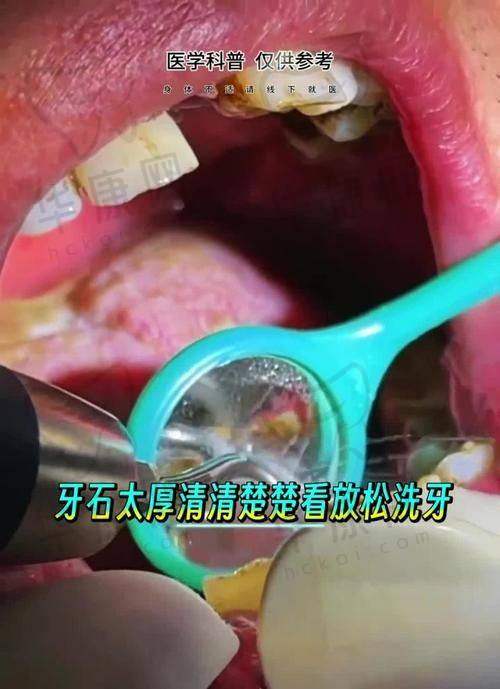 肥城可恩口腔医院在喷砂洁牙方面的特色优势