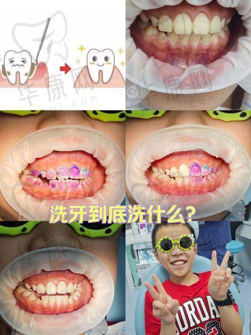 大连米嘉口腔超声波洁牙的质量保护