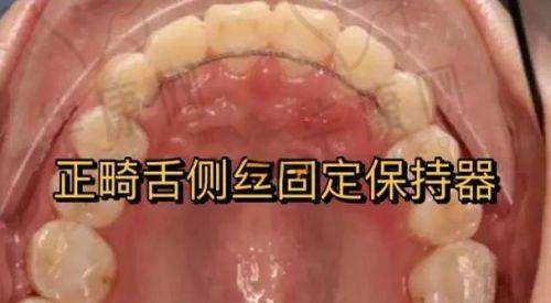 汕头牙加美口腔医院舌侧矫正45000元起，隐蔽正畸开启美观矫正新体验