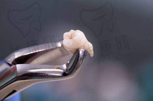 西双版纳竹子口腔医院下颌正位智齿拔除实例分享