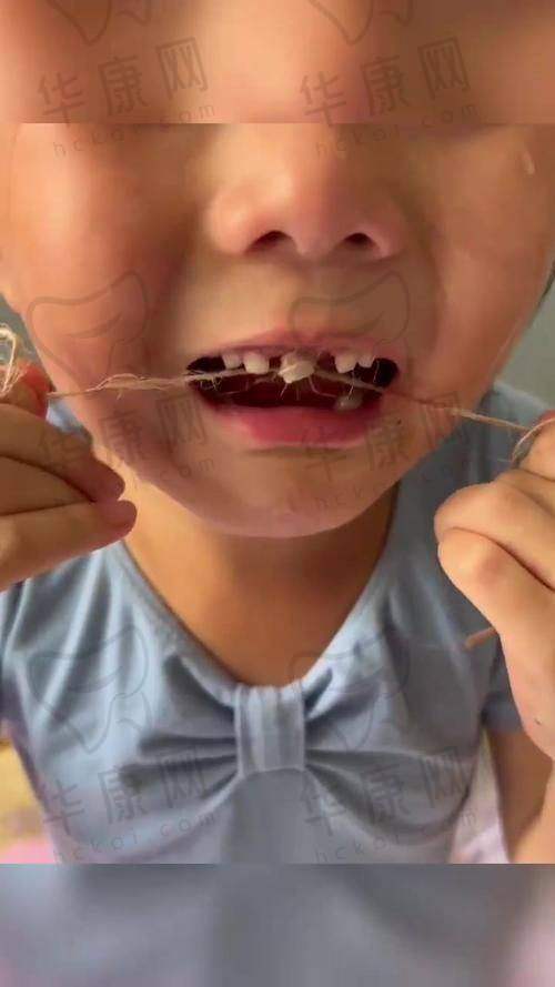 深圳贝壳口腔舒适下颌智齿拔除仅498元起，正规低价技术好超贴心！