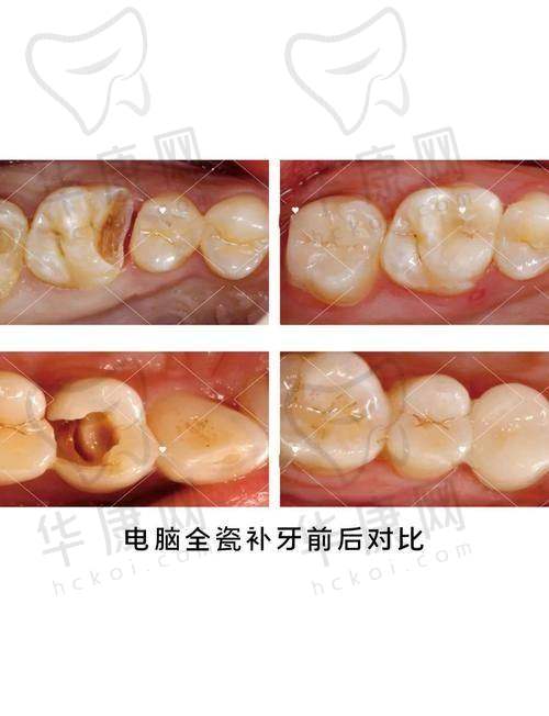 沈阳牙元素口腔嵌体修复之等待期间
