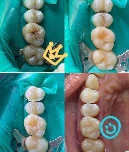 济南弗莱堡口腔儿童补牙之诊疗成效