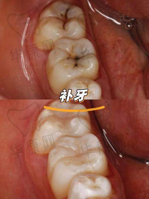 咸阳秦都海涛口腔医院瓷嵌体补牙的医生优势
