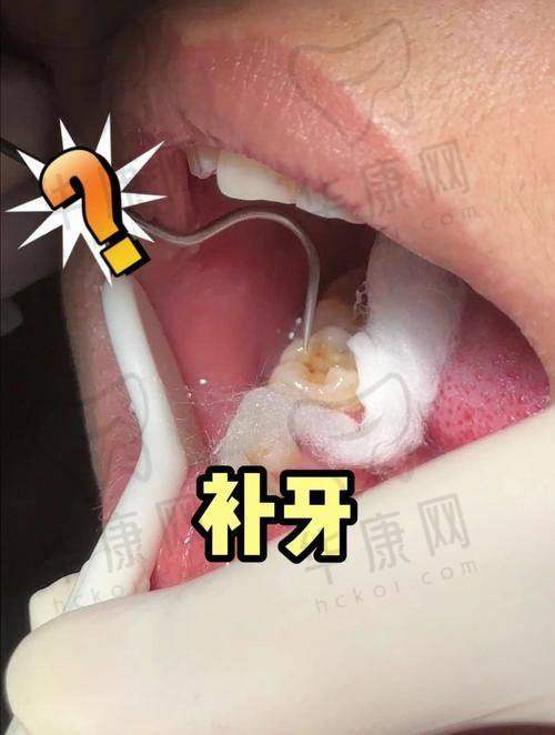 济南弗莱堡口腔儿童补牙之医生检查诊断