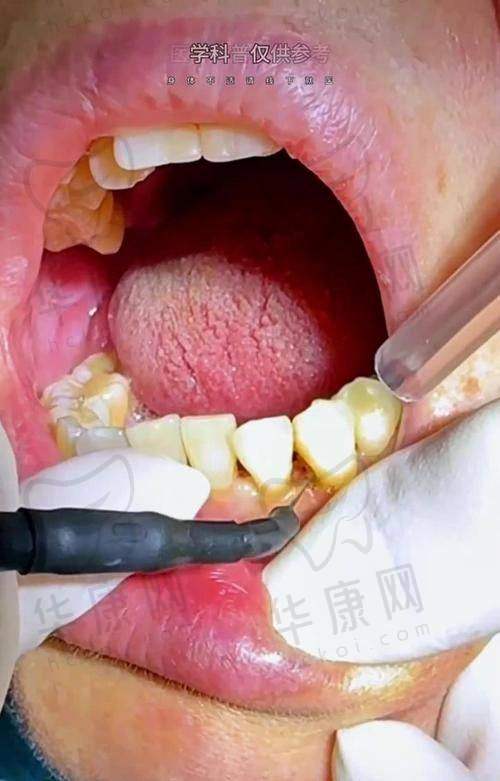 3MP60树脂补牙的优势