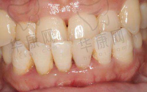 沈阳牙元素口腔嵌体修复之初次就诊