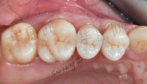 沈阳牙元素口腔嵌体修复之诊疗成效