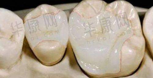 沈阳牙元素口腔嵌体修复之就诊感受