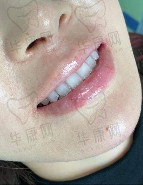 广州德仁口腔牙齿贴面的安装过程