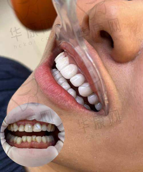 广州德仁口腔牙齿贴面的诊疗成效