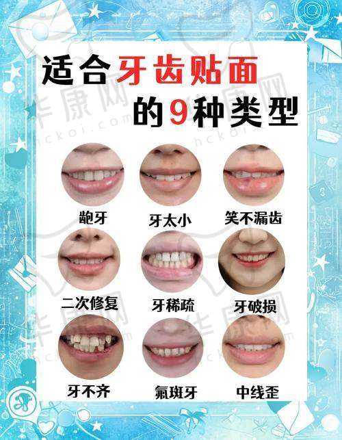 广州德仁口腔牙齿贴面的方案设计