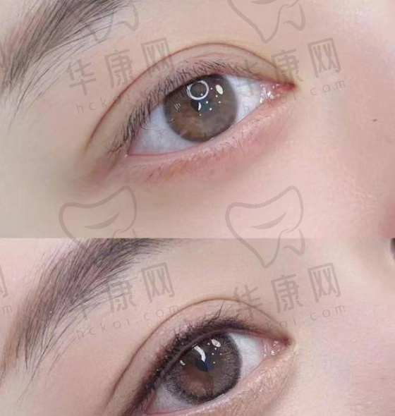郑州十大双眼皮医生做双眼皮真有这么神奇？风格多样价格4500-5800元任你选