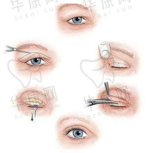 成都米兰柏羽双眼皮真实实例与顾客评价