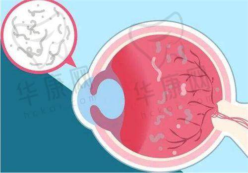 重庆华厦渝州眼科医院FLAP半飞秒近视手术的口碑实例