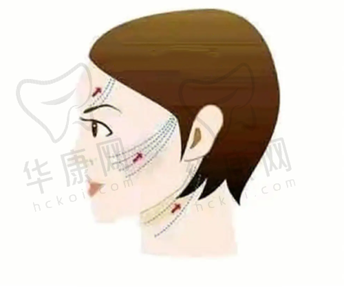 东莞东城爱思特医疗美容魏鑫铭脂肪填充之面诊过程